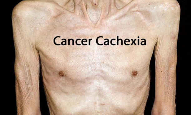 癌症恶液质有哪些症状？