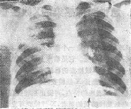 右肺化脓性肺炎之X线表现