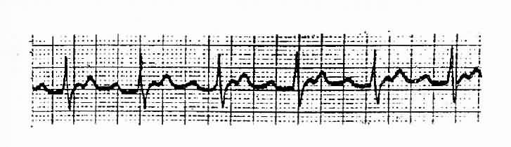 阵发性房性心动过速