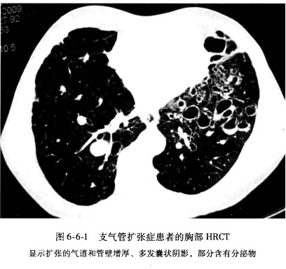 支气管扩张.jpg