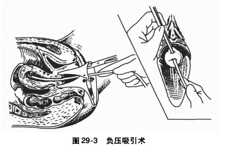 文件:负压吸引人工流产术.jpg