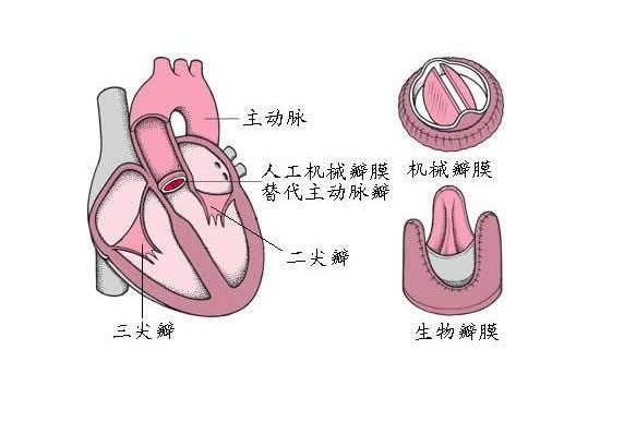 文件:瓣膜置换术.jpg