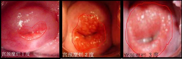 宫颈糜烂.jpg