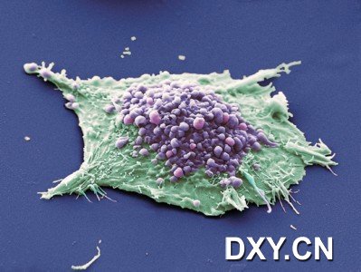 扫描电子显微镜下的肺癌细胞