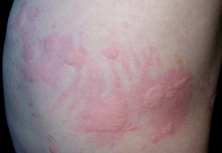 文件:荨麻疹.jpg