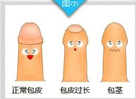 文件:包茎、包皮过长、正常包皮的对比.jpg