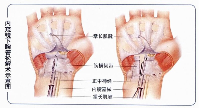 文件:腕管综合征手术治疗.jpg