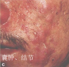 文件:痤疮结节囊肿.jpg