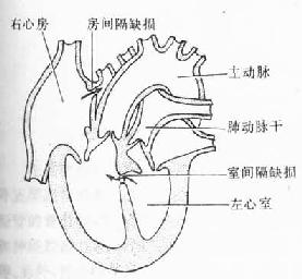 主动脉和肺动脉错位