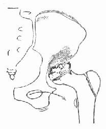 髋关节结核，股骨头及髋臼破坏