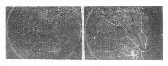 动脉早期荧光造影，显示视网膜睫状血管动脉期