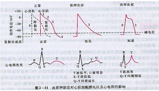 文件:血钾浓度异常EKG.jpg