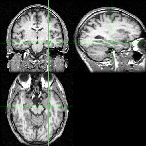 文件:Hippocampus-mri.jpg