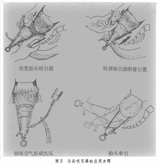 文件:胎头吸引器的应用步骤.jpg