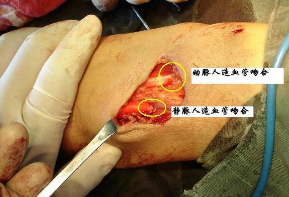 文件:动静脉造瘘.jpg