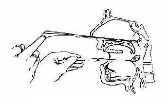 经鼻腔自鼻咽取活检