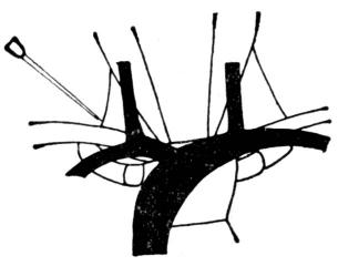 经锁骨上窝穿刺锁骨下静脉