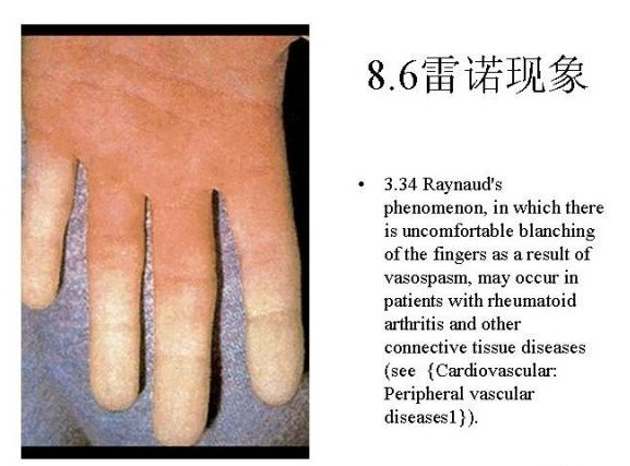文件:硬皮病雷诺氏现象.jpg