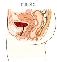 直肠突出。