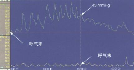 呼气末LES最大压力