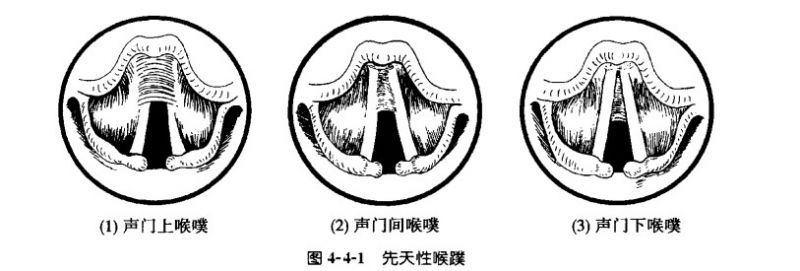 文件:先天性喉蹼.jpg