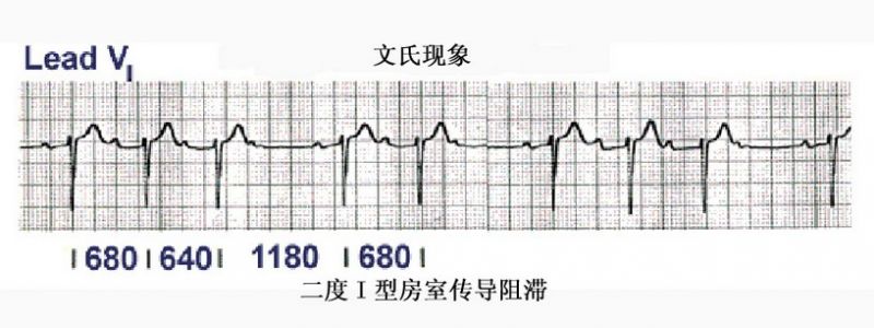 文件:房室传导阻滞.jpg