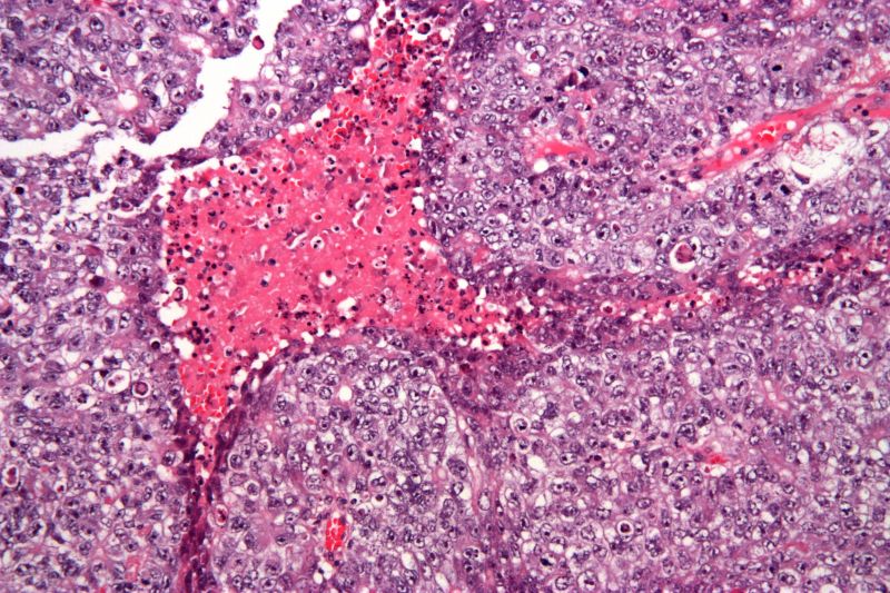 文件:Embryonal carcinoma - high mag.jpg