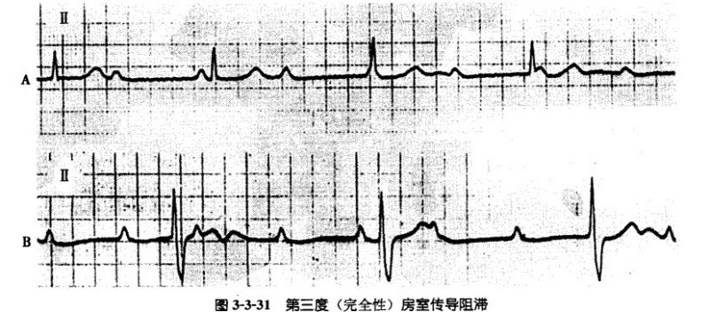 文件:第三度房室传导阻滞.jpg